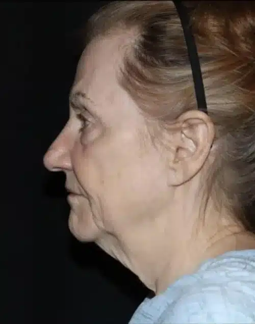 Face and Necklift Before and After Gallery