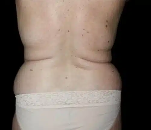 Liposuction Before and After Gallery