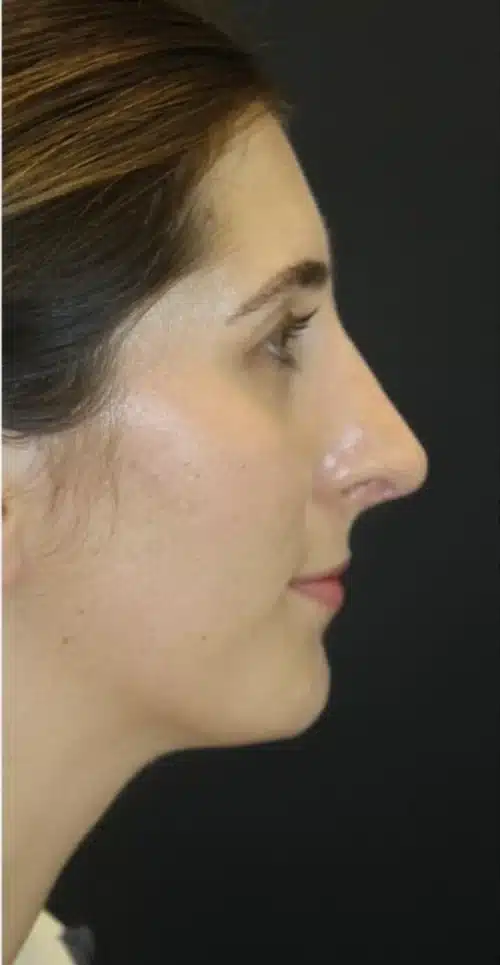 Rhinoplasty Before and After Gallery