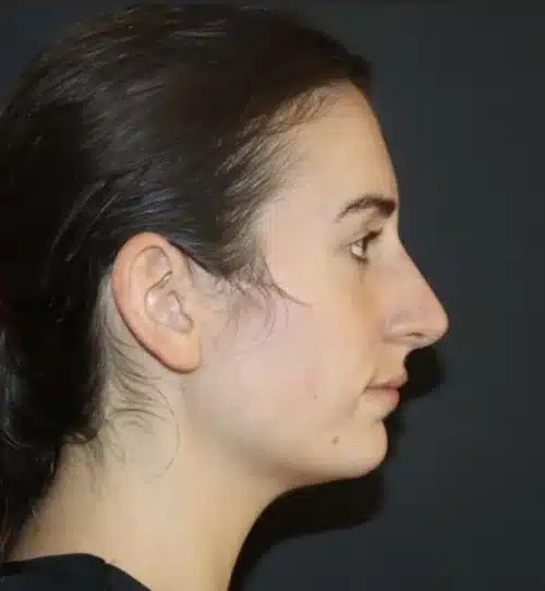 Rhinoplasty Before and After Gallery