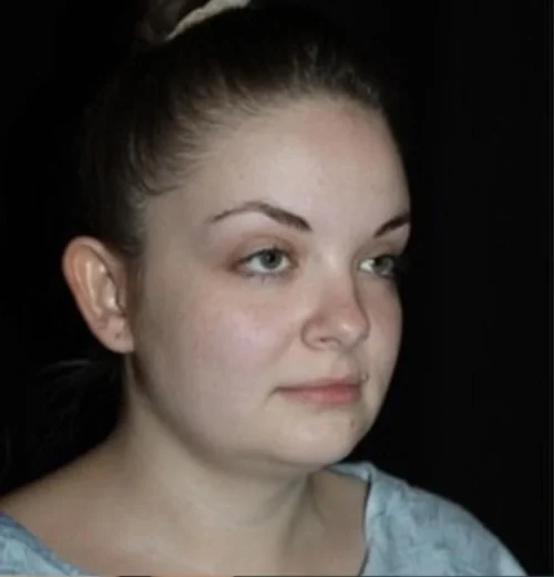 Submental Liposuction Before and After Gallery