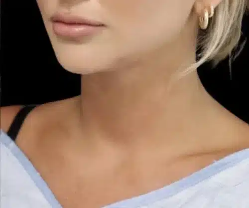 Submental Liposuction Before and After Gallery