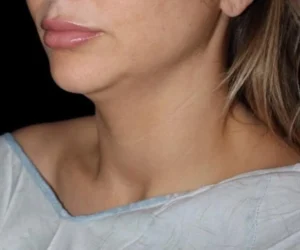 Submental Liposuction Before and After Gallery