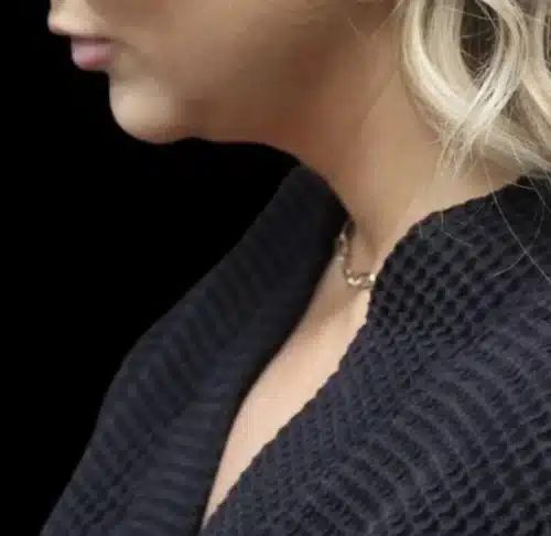 Submental Liposuction Before and After Gallery