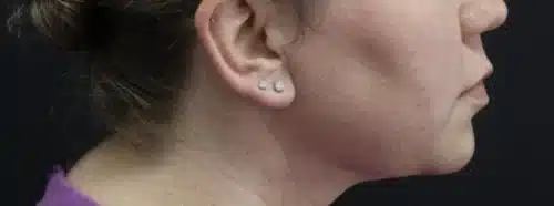 Submental Liposuction Before and After Gallery