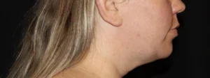 Submental Liposuction Before and After Gallery