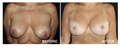 Breast Implant Exchange