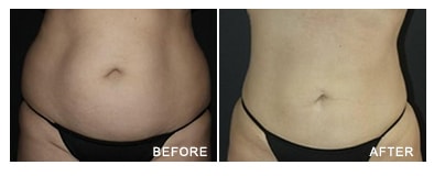Liposuction