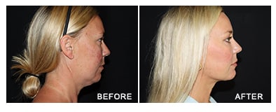 Submental Liposuction