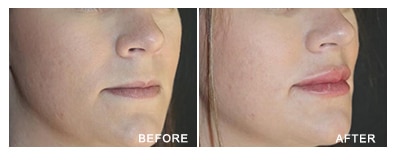 Juvederm Volbella