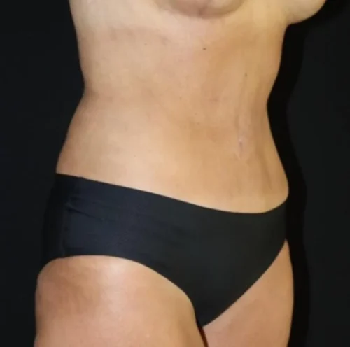 Tummy Tuck Before and After Gallery