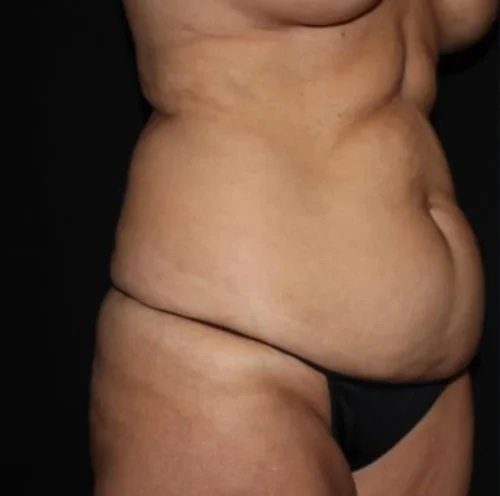 Tummy Tuck Before and After Gallery