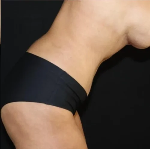 Tummy Tuck Before and After Gallery